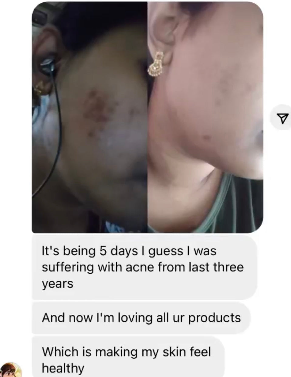 Acne care kit “say bye bye to acne”